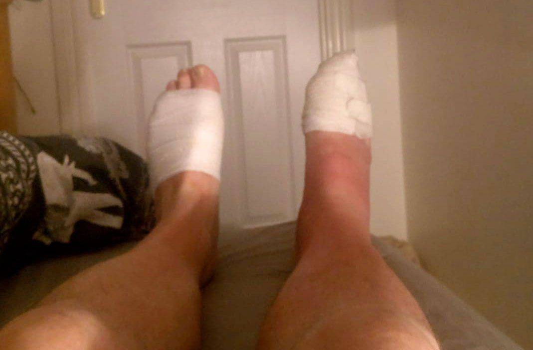 Hiding sped bandaged ankle beneath sock