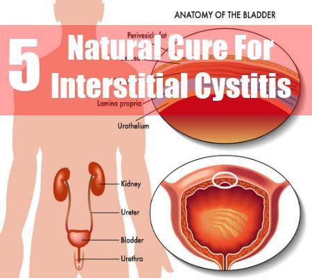 Interstitial cystitis and orgasm
