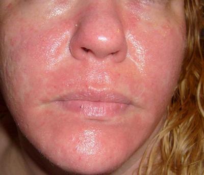 Good в. P. reccomend Facial rashes in adults