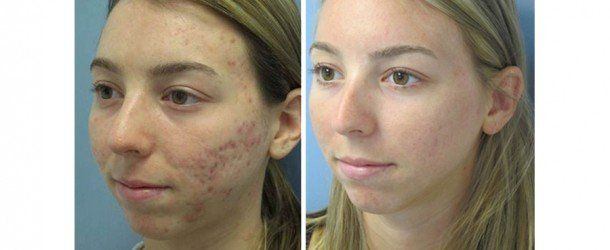 Zils M. reccomend Acne scar facial resurfacing stories