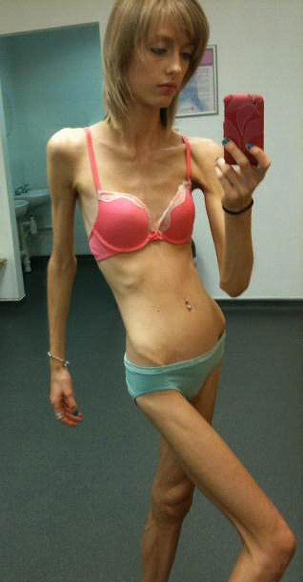 Catfish reccomend Anorexic woman wearing bikini photo