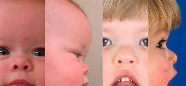 best of Structure by Craniofacial anomalies ethnicity facial