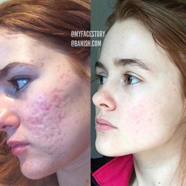 best of Facial Acne stories scar resurfacing
