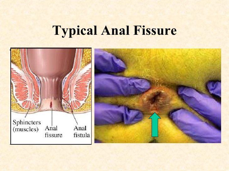 Lunar reccomend Anal nitro paste for anal fissure