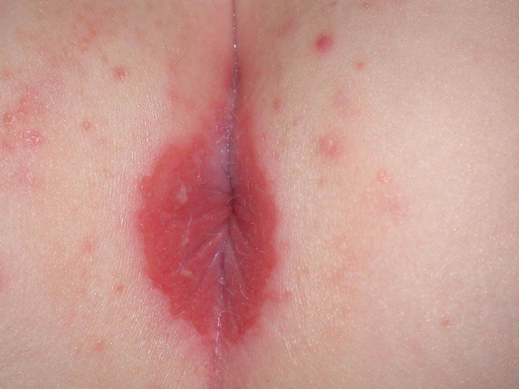 Skin around the anus sore pain