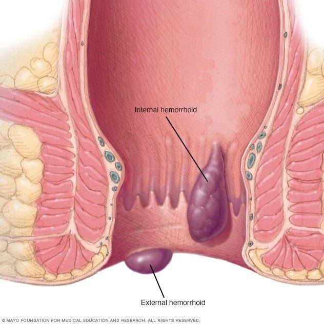 Urinary tract infection clitoris