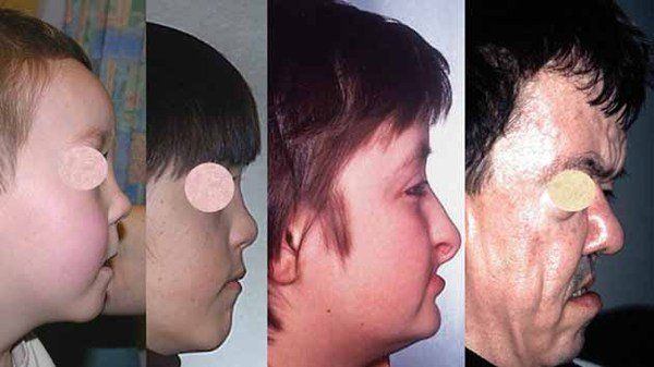 Lunar reccomend Craniofacial anomalies by ethnicity facial structure