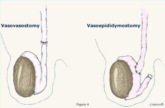 Pecan reccomend Non motile sperm after vasectomy reversal