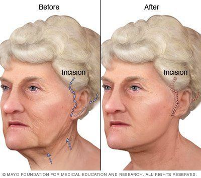 Facial swelling face lift