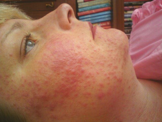 Facial rashes in adults