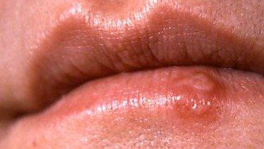 Trigger reccomend Oral herpes 2
