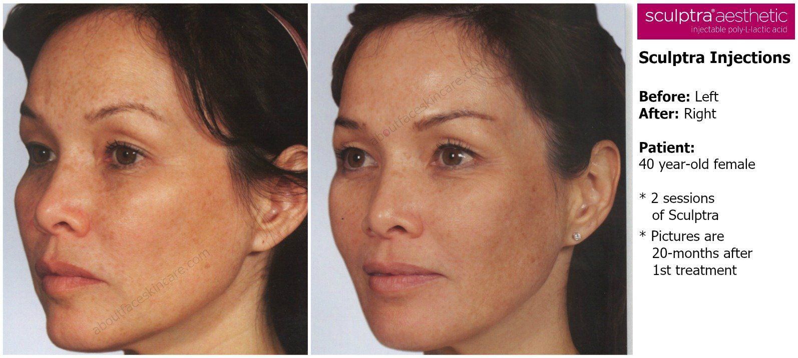 Cocktail facial injections plastic injections