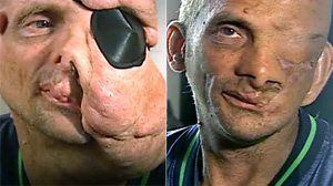 best of Facial Seattle man surgery gets