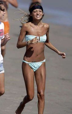 Louis-Vuitton reccomend Anorexic woman wearing bikini photo