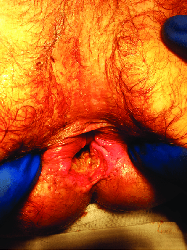 Closeup anal cavity