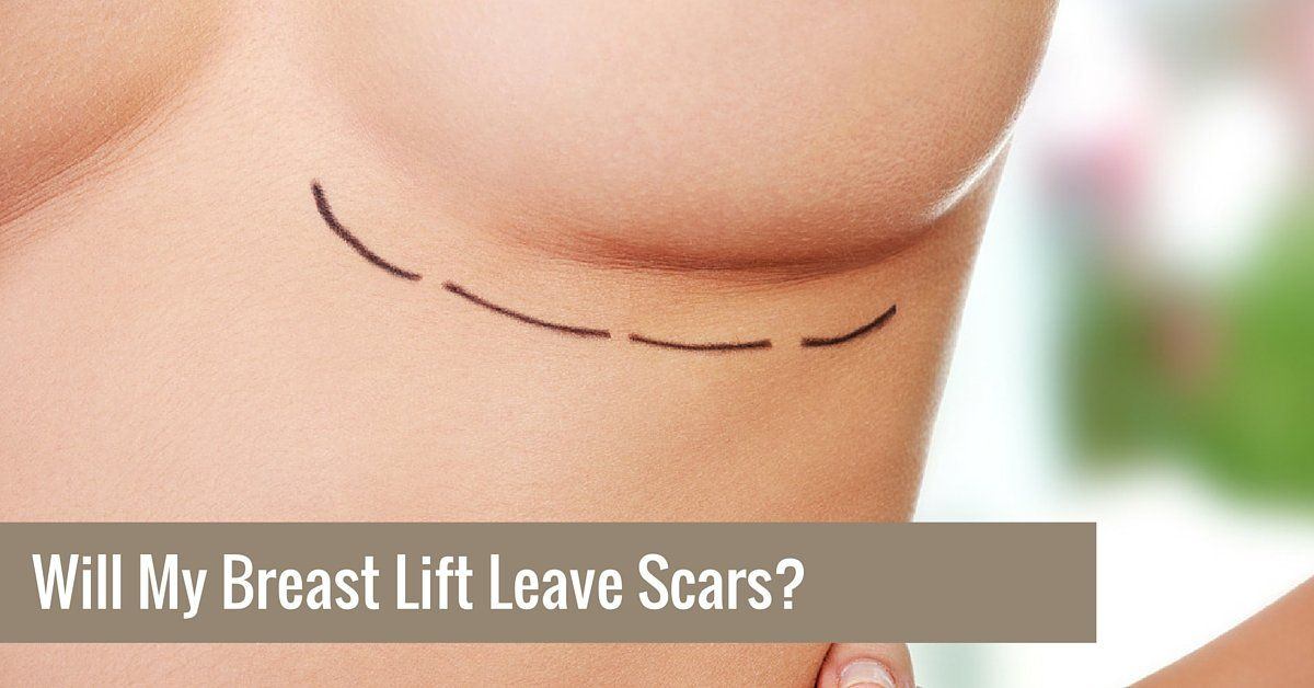 The S. reccomend Boob lift scars