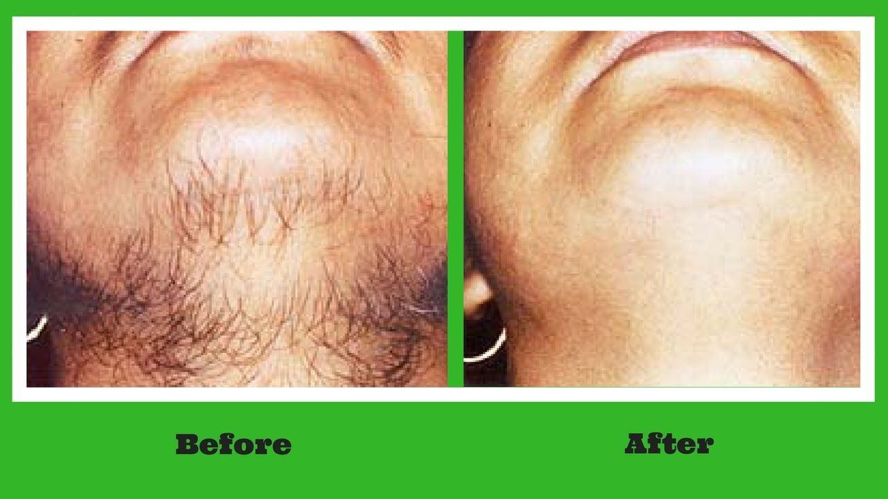 best of Home facial removal permanent hair At