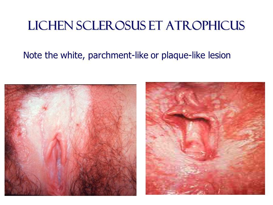 Clutch reccomend Lichen sclerosis clitoris