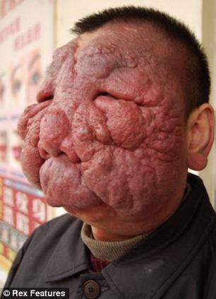 FLAK reccomend Chinese man with facial tumor