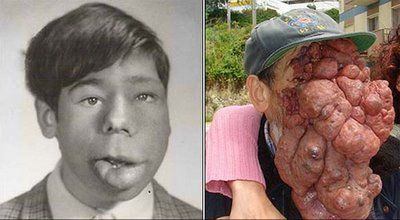 best of Tumor Chinese man with facial