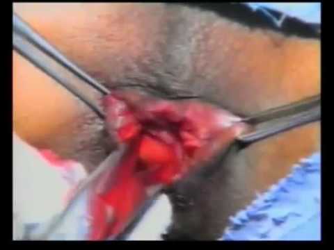 Anal fissure type of surgeon