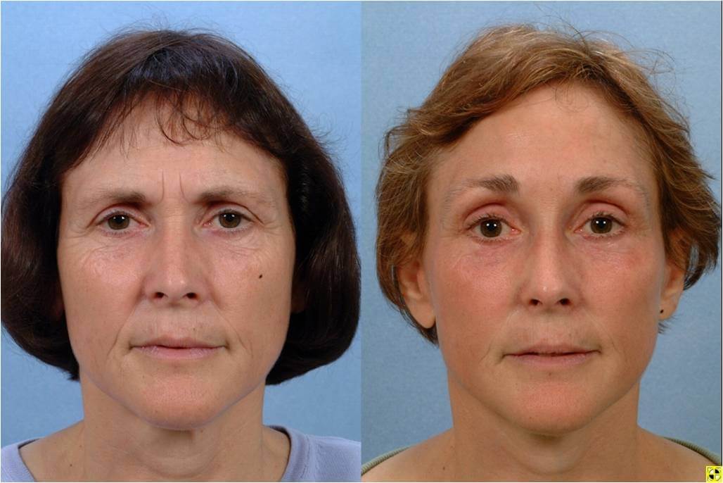 best of Reconstructive facial plastic surgery Types of