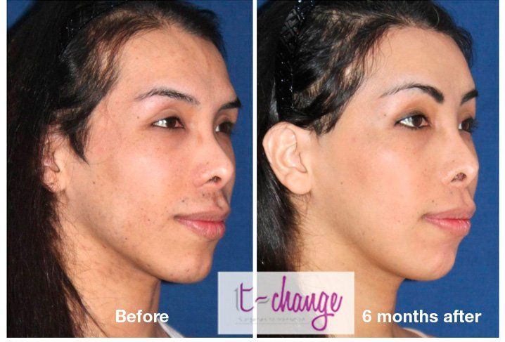 Bass reccomend Facial feminization before and after pictures