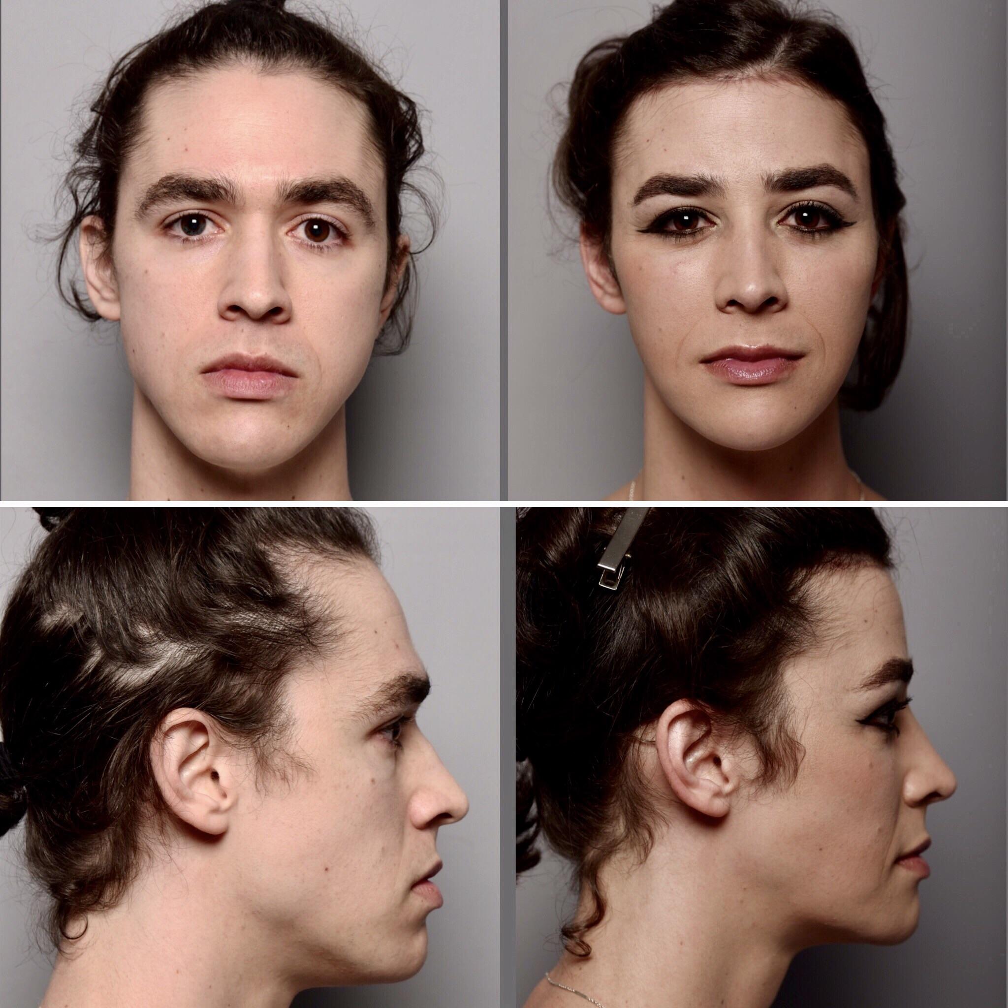 best of Surgery facial Dr zukowski feminization