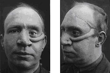 First facial reconstruction