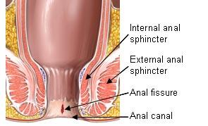 Anal fissure type of surgeon