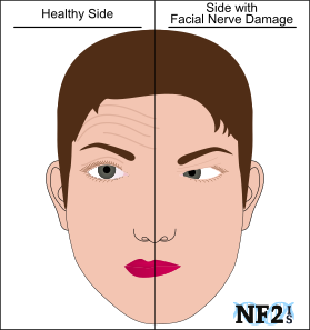 Facial nerve damage and perforated eardrum