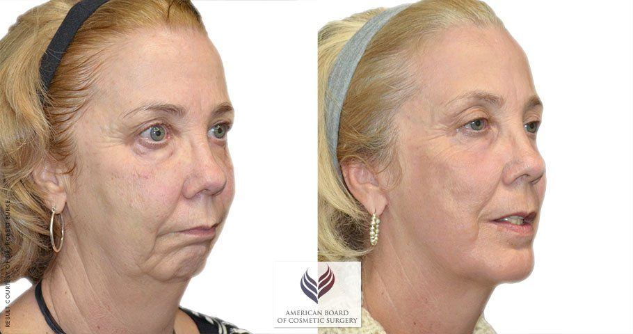 best of Face Facial lift swelling