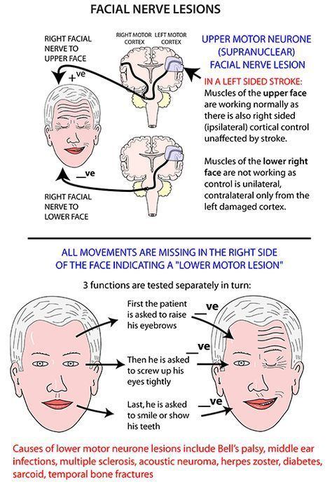Facial weakness multiple sclerosis
