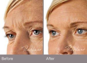 best of Restalyn Facial wrinkles