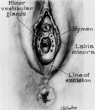 How deep in the vagina is the hymen