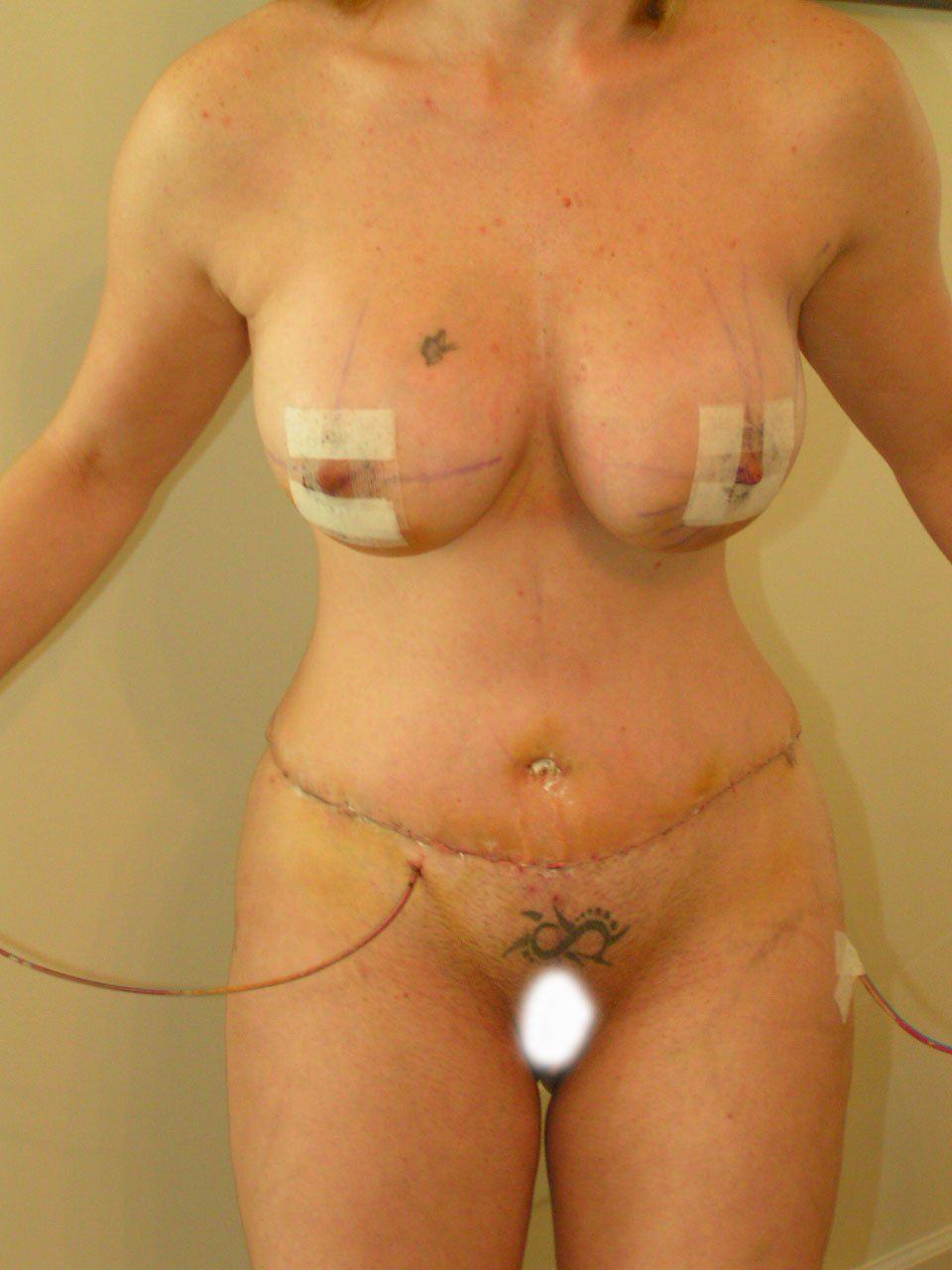 Large breast implants nude