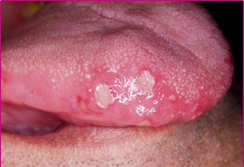 Oral herpes 2