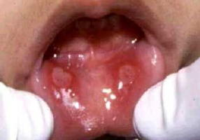best of 2 Oral herpes