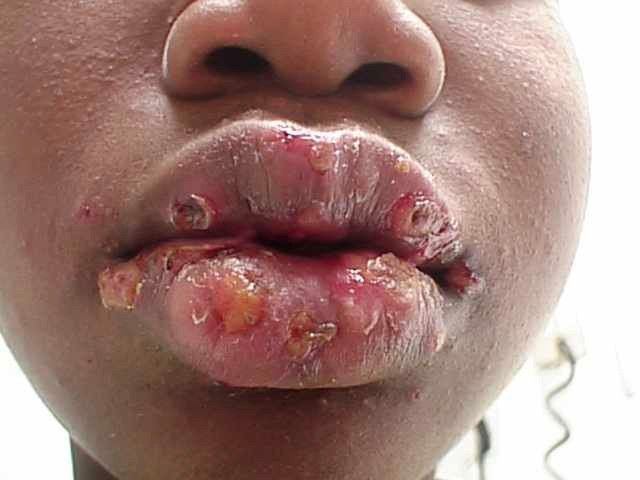 Oral herpes 2