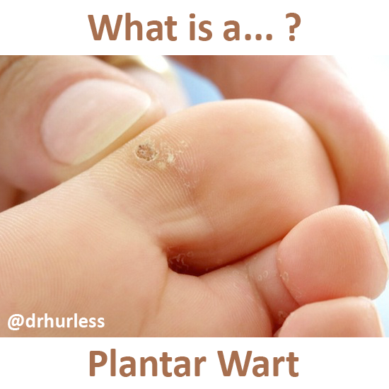 best of Wart foot of Plantar bottom
