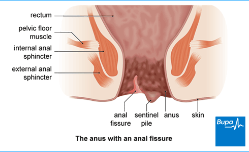 Snout reccomend Treating anal open sore
